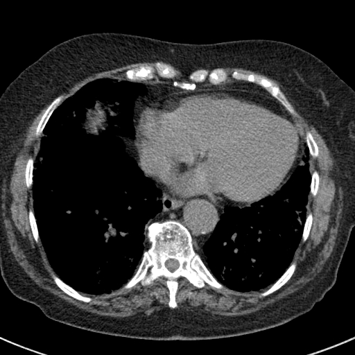 File:Amiodarone-induced pulmonary fibrosis (Radiopaedia 82355-96460 Axial non-contrast 43).jpg