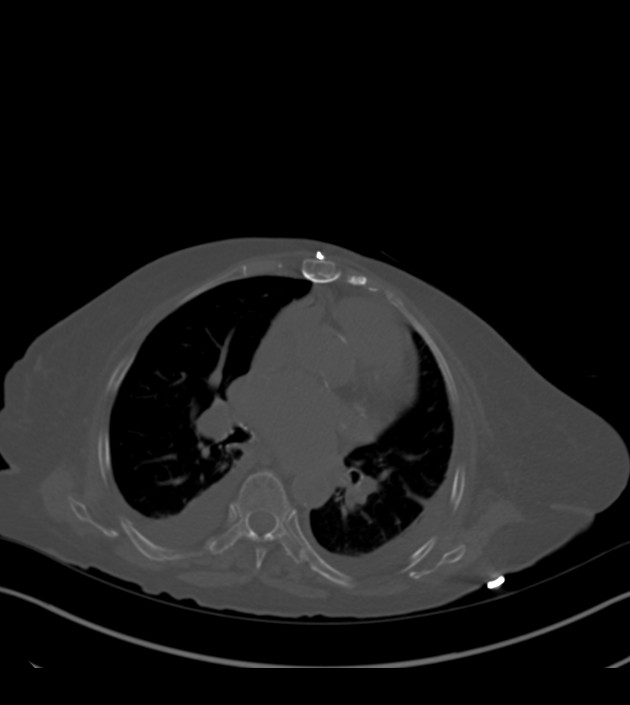 Amiodarone deposition in the liver (Radiopaedia 77587-89780 Axial bone window 42).jpg