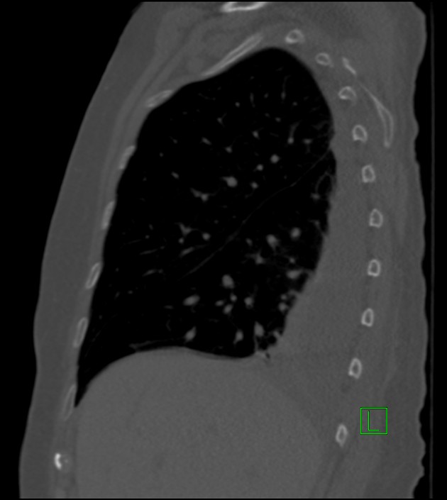 Amiodarone deposition in the liver (Radiopaedia 77587-89780 Sagittal bone window 71).jpg