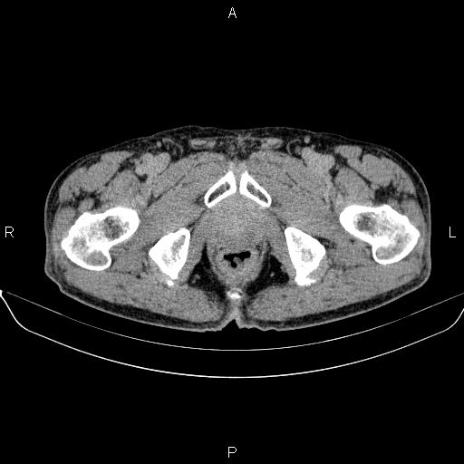 Ampullary adenocarcinoma (Radiopaedia 86093-102032 Axial C+ delayed 108).jpg