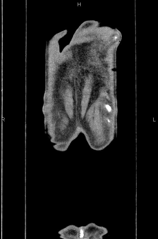 Ampullary adenocarcinoma (Radiopaedia 86093-102033 D 64).jpg