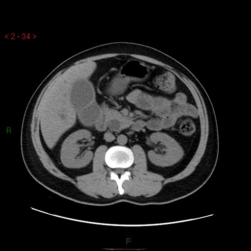 File:Ampullary carcinoma (Radiopaedia 56396-63056 Axial non-contrast 23).jpg