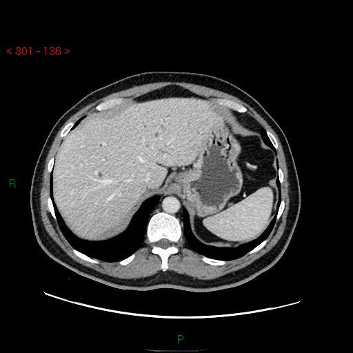 Ampullary carcinoma (Radiopaedia 56396-63056 C 18).jpg