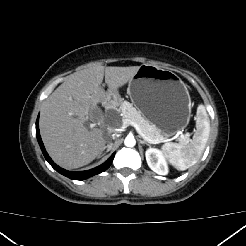 Ampullary tumor (Radiopaedia 22787-22816 B 26).jpg