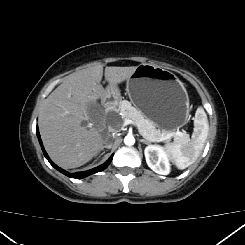 Ampullary tumor (Radiopaedia 22787-22816 B 27).jpg