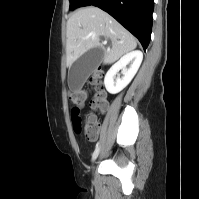 Ampullary tumor (Radiopaedia 22787-22816 D 18).jpg