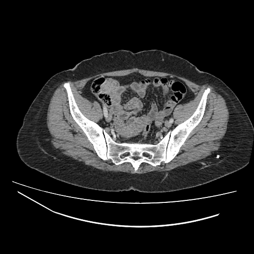 File:Ampullary tumor (Radiopaedia 60333-67998 A 73).jpg