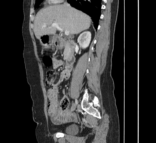Ampullary tumor (Radiopaedia 60333-67998 C 21).jpg