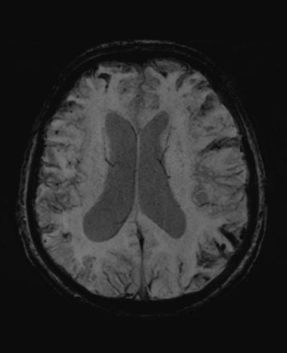 File:Amyloid angiopathy with inflammation (Radiopaedia 30360-31002 Axial SWI MIP 36).jpg