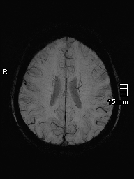 File:Amyotrophic lateral sclerosis (Radiopaedia 70821-81017 Axial SWI minIP 34).jpg