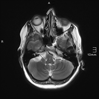 File:Amyotrophic lateral sclerosis (Radiopaedia 70821-81017 Axial T2 7).jpg