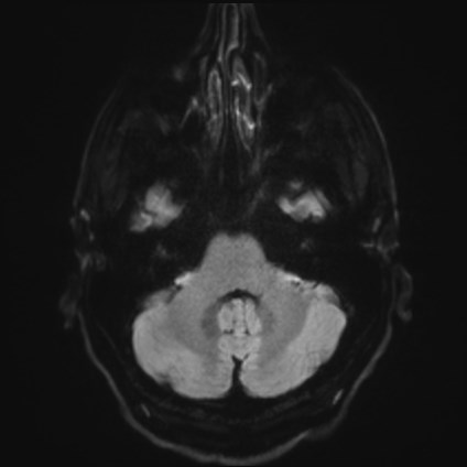 Amyotrophic lateral sclerosis (Radiopaedia 87352-103658 Axial DWI 33).jpg