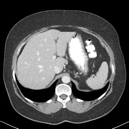 File:Anal adenocarcinoma - tumor regression grade 1 (Radiopaedia 31358-32103 Axial POST 18).jpg
