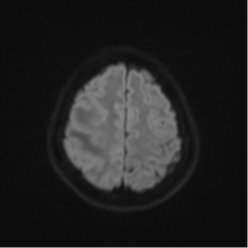 Anaplastic astroblastoma (Radiopaedia 55666-62194 Axial DWI 51).png