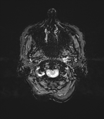 File:Anaplastic astrocytoma (Radiopaedia 86943-103160 Axial SWI 7).png
