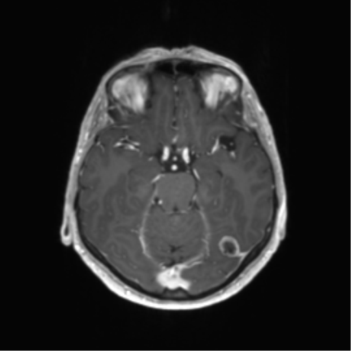 File:Anaplastic astrocytoma (Radiopaedia 86943-103160 Axial T1 C+ 10).png