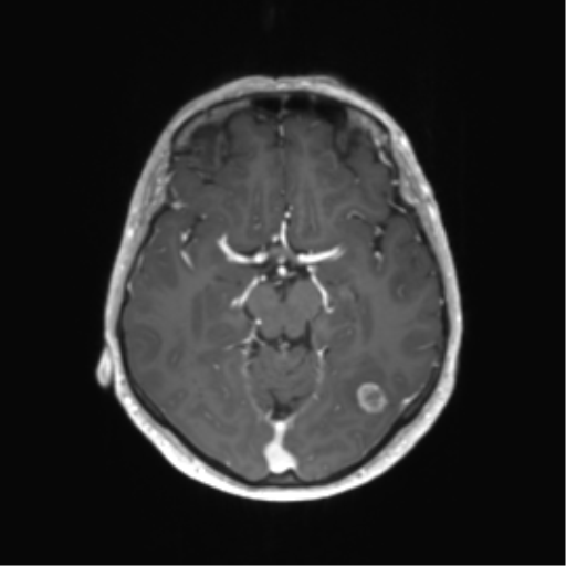 File:Anaplastic astrocytoma (Radiopaedia 86943-103160 Axial T1 C+ 14).png