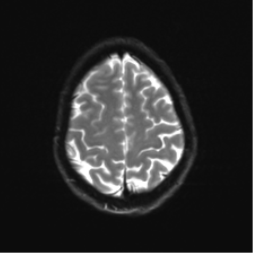 Anaplastic astrocytoma IDH mutant (Radiopaedia 50046-55341 Axial DWI 23).png