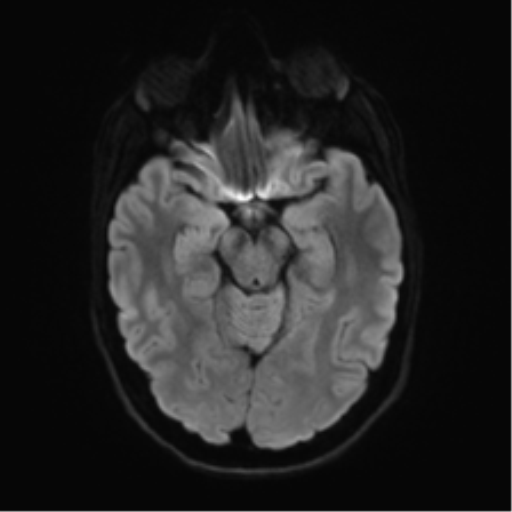 Anaplastic astrocytoma IDH mutant (Radiopaedia 50046-55341 Axial DWI 38).png