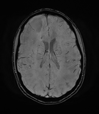 File:Anaplastic astrocytoma IDH mutant (Radiopaedia 50046-55341 Axial SWI 54).png