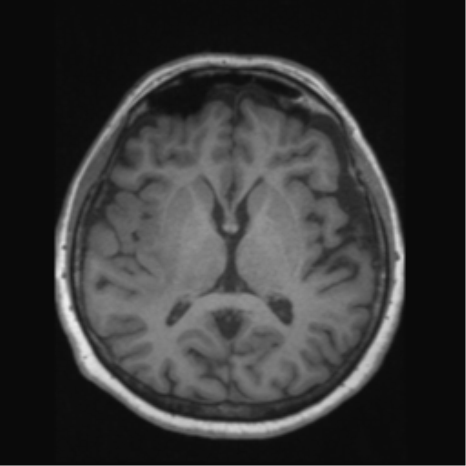 Anaplastic astrocytoma IDH wild-type (pseudoprogression) (Radiopaedia 42209-45276 Axial T1 82).png