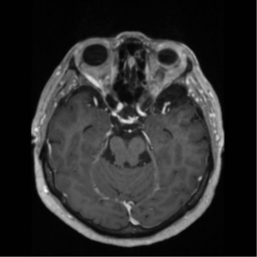 File:Anaplastic astrocytoma IDH wild-type (pseudoprogression) (Radiopaedia 42209-45276 Axial T1 C+ 58).png