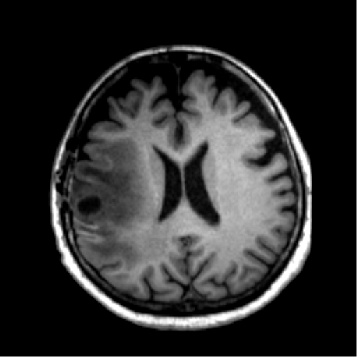 Anaplastic astrocytoma IDH wild-type (pseudoprogression) (Radiopaedia 42209-45277 Axial T1 83).png