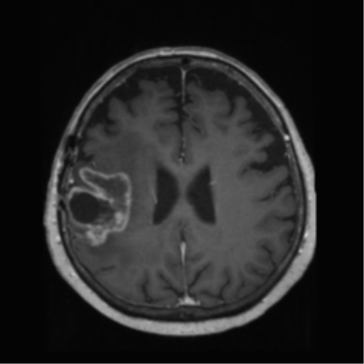 File:Anaplastic astrocytoma IDH wild-type (pseudoprogression) (Radiopaedia 42209-45278 Axial T1 C+ 101).png