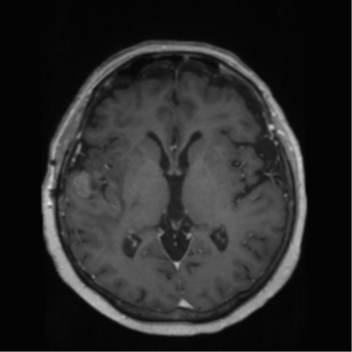 File:Anaplastic astrocytoma IDH wild-type (pseudoprogression) (Radiopaedia 42209-45278 Axial T1 C+ 82).png
