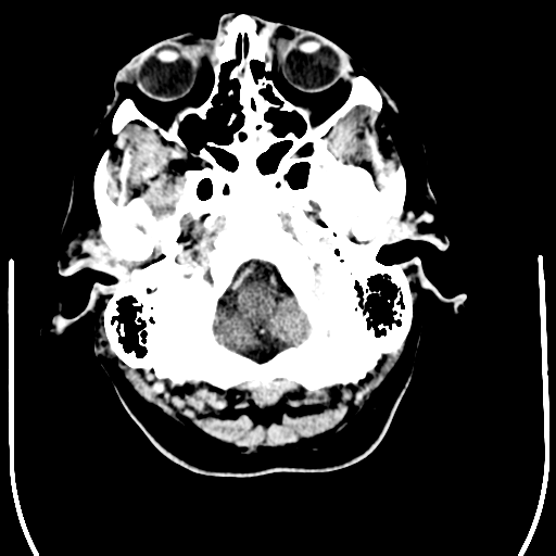 File:Anaplastic meningioma with recurrence (Radiopaedia 34452-35781 Axial Contrast 4).png