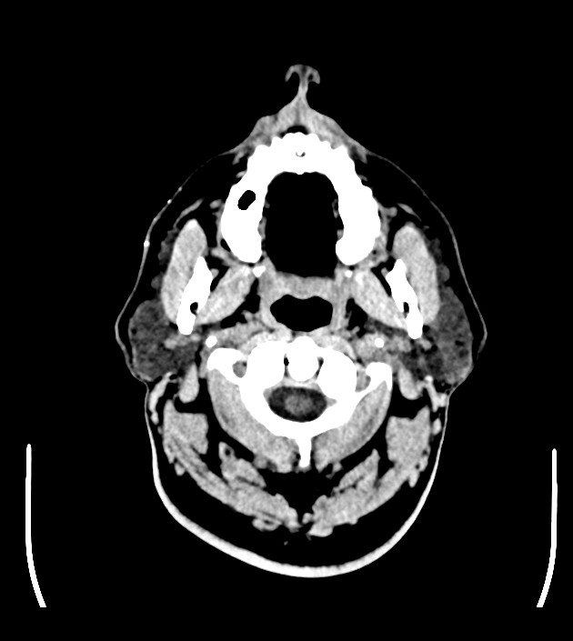 Anaplastic oligodendroglioma (Radiopaedia 79571-92753 Axial non-contrast 2).jpg
