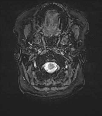 Anaplastic oligodendroglioma (Radiopaedia 83500-98599 Axial SWI 1).png
