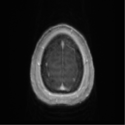 Anaplastic oligodendroglioma (Radiopaedia 83500-98599 Axial T1 C+ 70).png