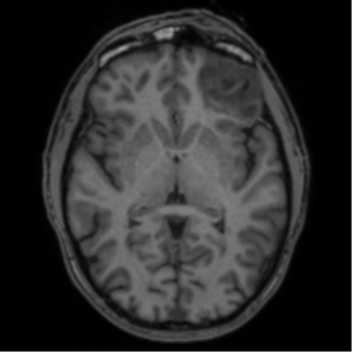 Anaplastic oligodendroglioma with skull fracture (Radiopaedia 74831-85845 Axial T1 31).png