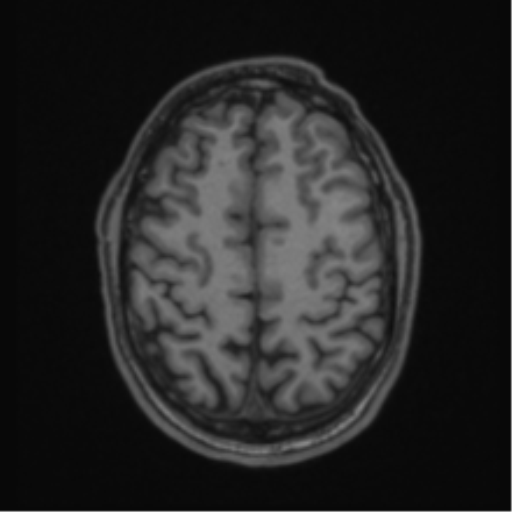 Anaplastic oligodendroglioma with skull fracture (Radiopaedia 74831-85845 Axial T1 51).png