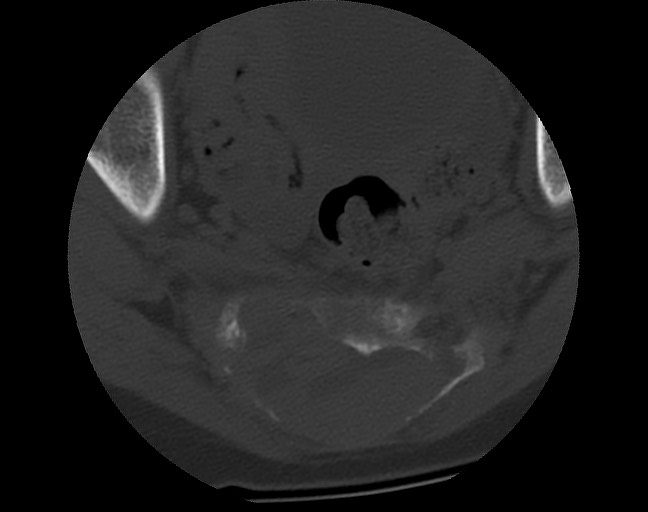 Aneurysmal bone cyst - sacrum (Radiopaedia 65190-74195 Axial bone window 33).jpg