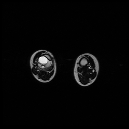 File:Aneurysmal bone cyst - tibia (Radiopaedia 22343-22367 Axial T2 11).jpg