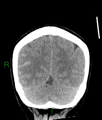 Aneurysmal subarachnoid hemorrhage with intra-axial extension (Radiopaedia 84371-99699 Coronal non-contrast 20).jpg
