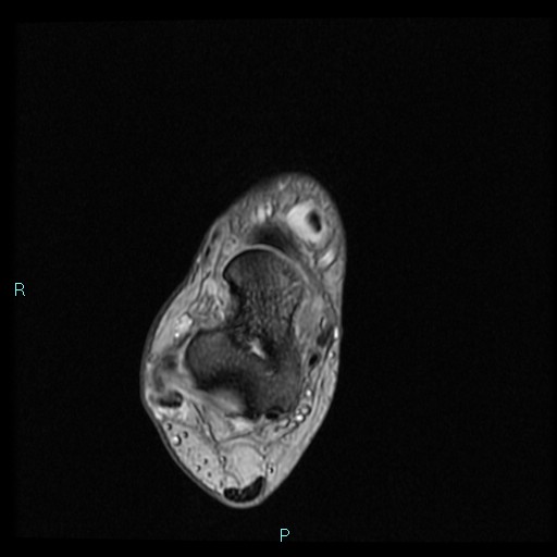 Ankle ganglion cyst (Radiopaedia 62809-71162 Axial Gradient Echo 48).jpg