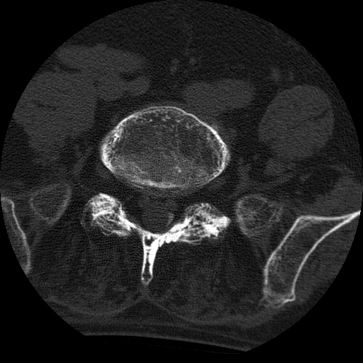 Ankylosing spondylitis complicated by fracture-dislocation (Radiopaedia 33583-34674 Axial non-contrast 136).jpg