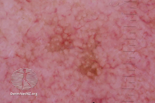 File:Annular granular pattern seen in pigmented actinic keratosis (DermNet NZ pigmented-actinic-keratosis-TSNA).jpg