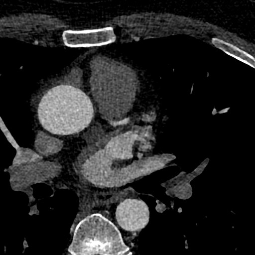 File:Anomalous origin of the left coronary artery with malignant course (Radiopaedia 77842-90126 C 10).jpeg