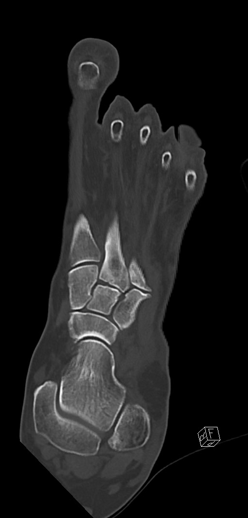Anterior calcaneal process fracture (Radiopaedia 63353-71943 Coronal bone window 18).jpg