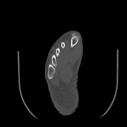 File:Anterior calcaneal process fracture (Radiopaedia 82590-96762 Axial bone window 36).jpg