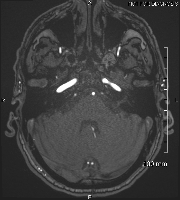 Anterior cerebral artery aneurysm (Radiopaedia 80683-94127 Axial MRA 52).jpg