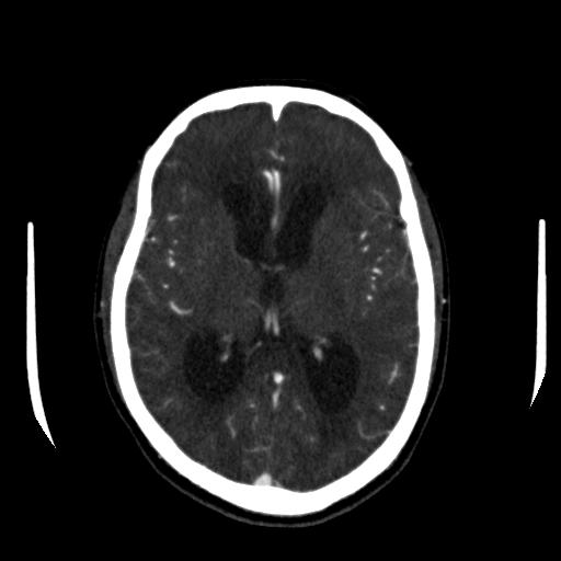 File:Anterior communicating artery aneurysm (Radiopaedia 16633-16335 A 23).jpg