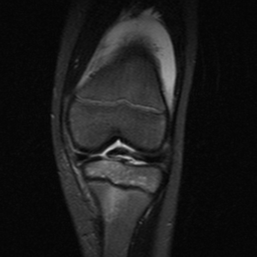 File:Anterior cruciate ligament avulsion fracture (Radiopaedia 24710-24974 Coronal STIR 5).jpg