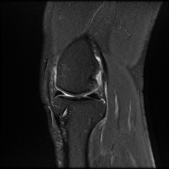 File:Anterior cruciate ligament graft tear and bucket-handle tear of medial meniscus (Radiopaedia 75867-87254 Sagittal PD fat sat 10).jpg