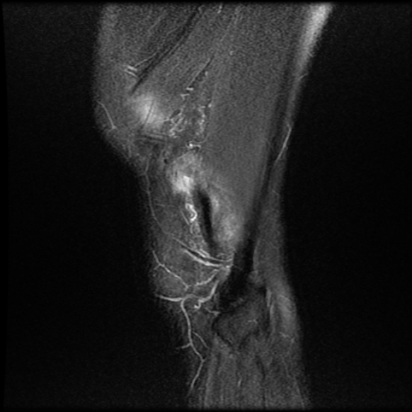 File:Anterior cruciate ligament graft tear and bucket-handle tear of medial meniscus (Radiopaedia 75867-87255 Sagittal PD fat sat 27).jpg