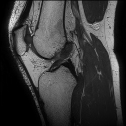 Anterior cruciate ligament rupture and posteromedial corner injury (Radiopaedia 67338-76723 Sagittal PD 91).jpg